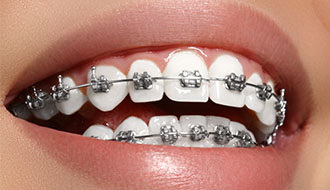 拔了八顆牙齒 矯牙后大變樣！