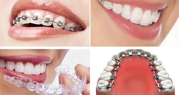 順德德倫口腔四大矯正方法