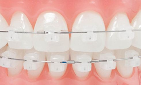 數字化陶瓷托槽半隱形矯治器