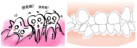 牙齒不齊多少錢