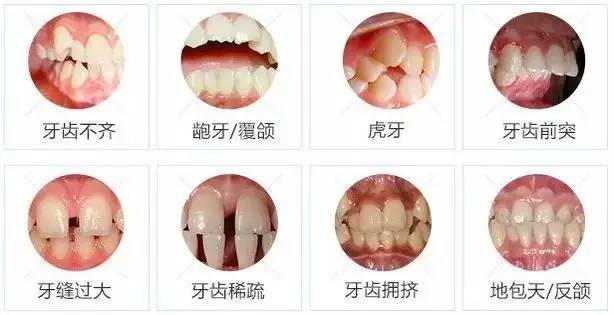 牙齒畸形