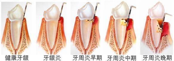 牙周病