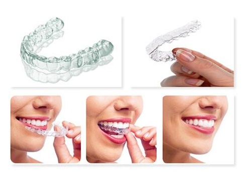 隱適美隱形矯正