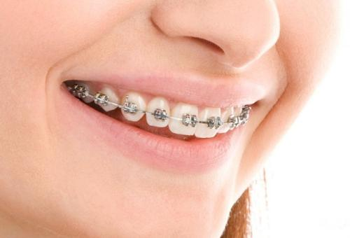 大良自鎖托槽矯正