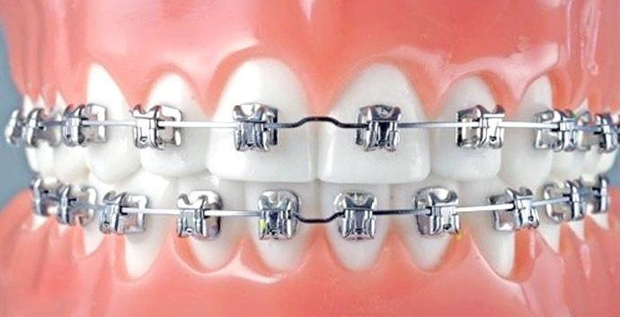 大良自鎖托槽矯正