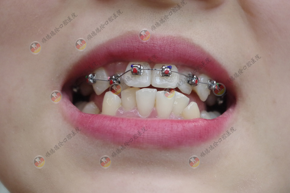 順德矯正牙齒