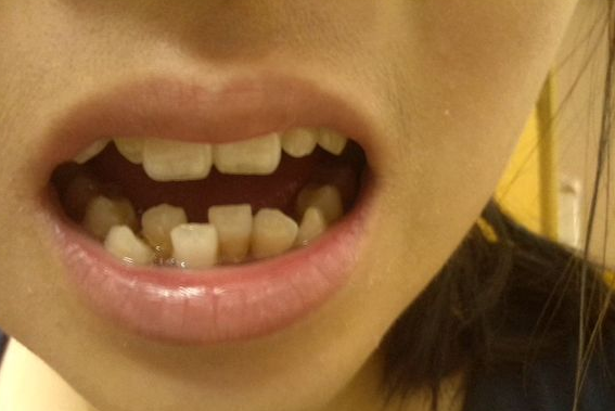 牙齒不齊的危害