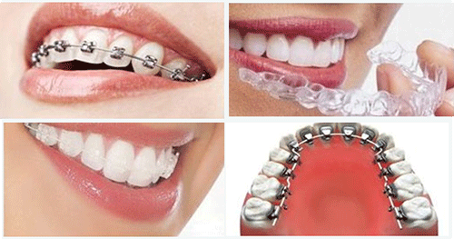 牙齒矯正