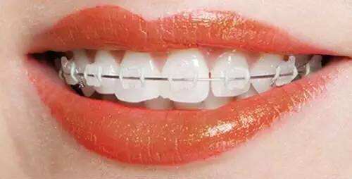 數(shù)字化陶瓷托槽矯正